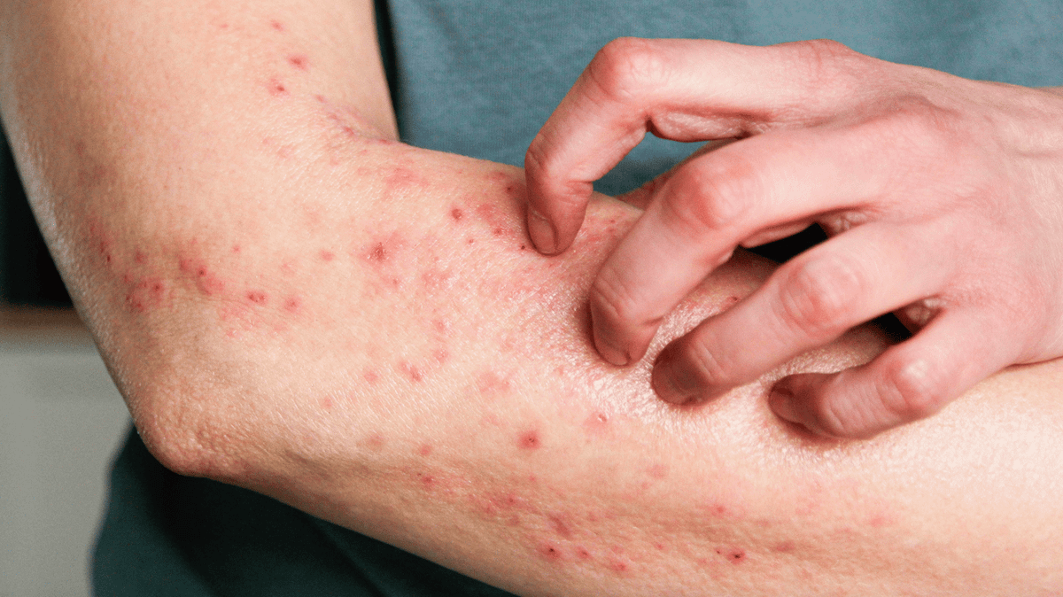 Reason psoriasis and eczema are flaring up for so many Brits right now