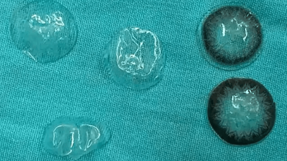 Doctors issue warning after removing five contact lenses from behind ...