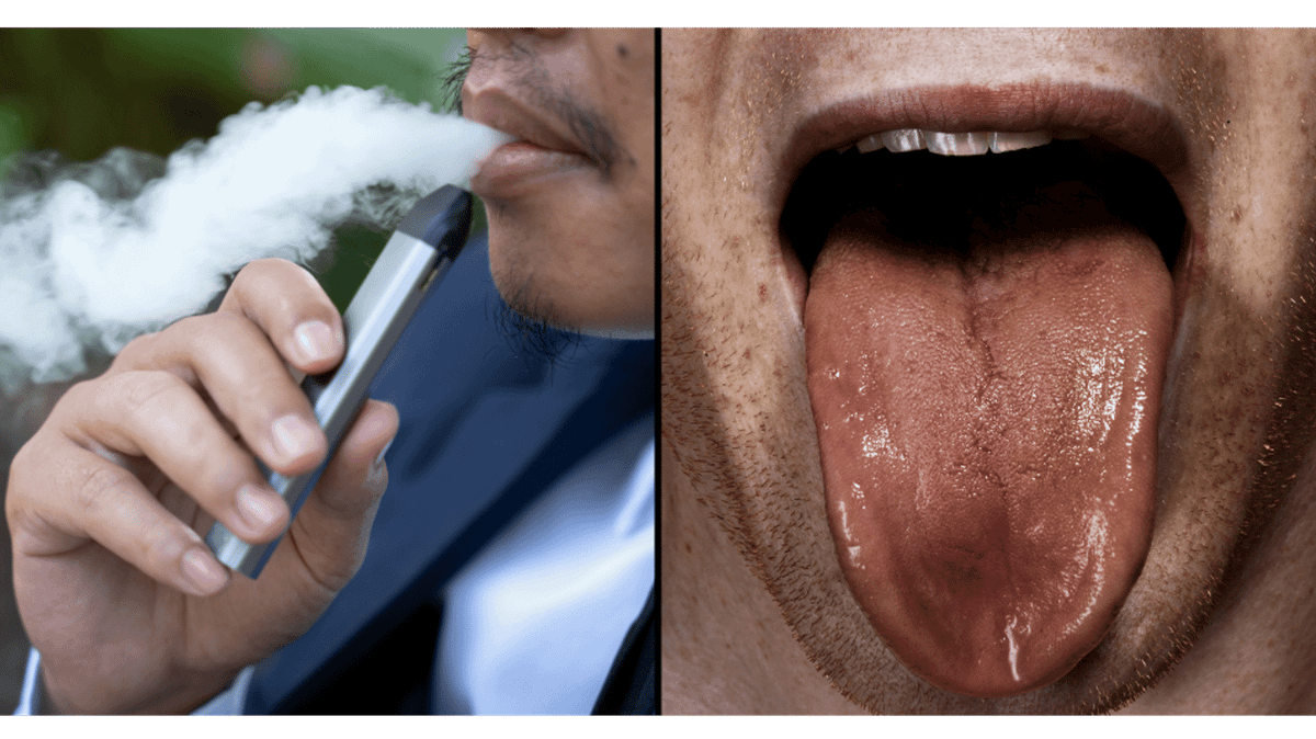 can you put out a cigarette on your tongue Dentist issues warning over 'Vaper's Tongue' this Christmas