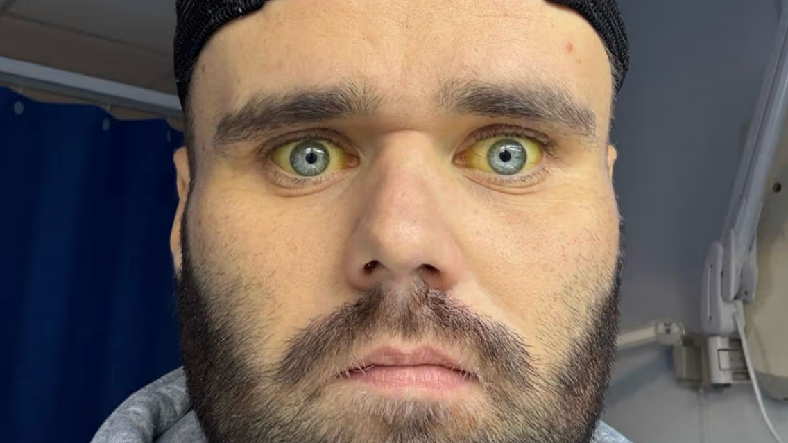 Man who drank six bottles of wine a day shares horrific impact it had on health