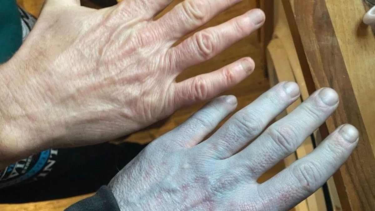 Man woke up blue and was rushed to hospital before doctors ‘laughed’ at him