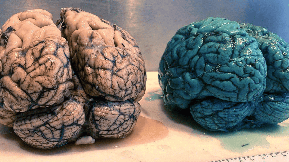 Doctor reveals patient's brain turned blue after taking 'limitless pill ...
