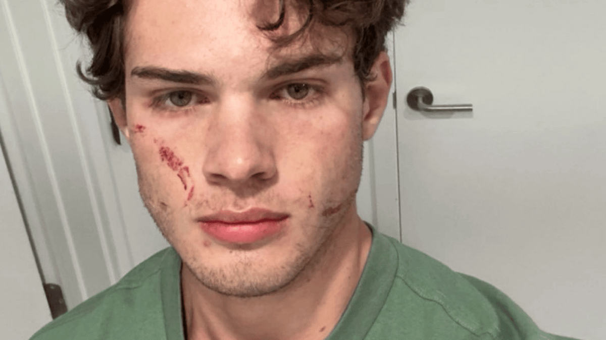 Looksmaxxing Influencer Clavicular Hospitalized After Overdose