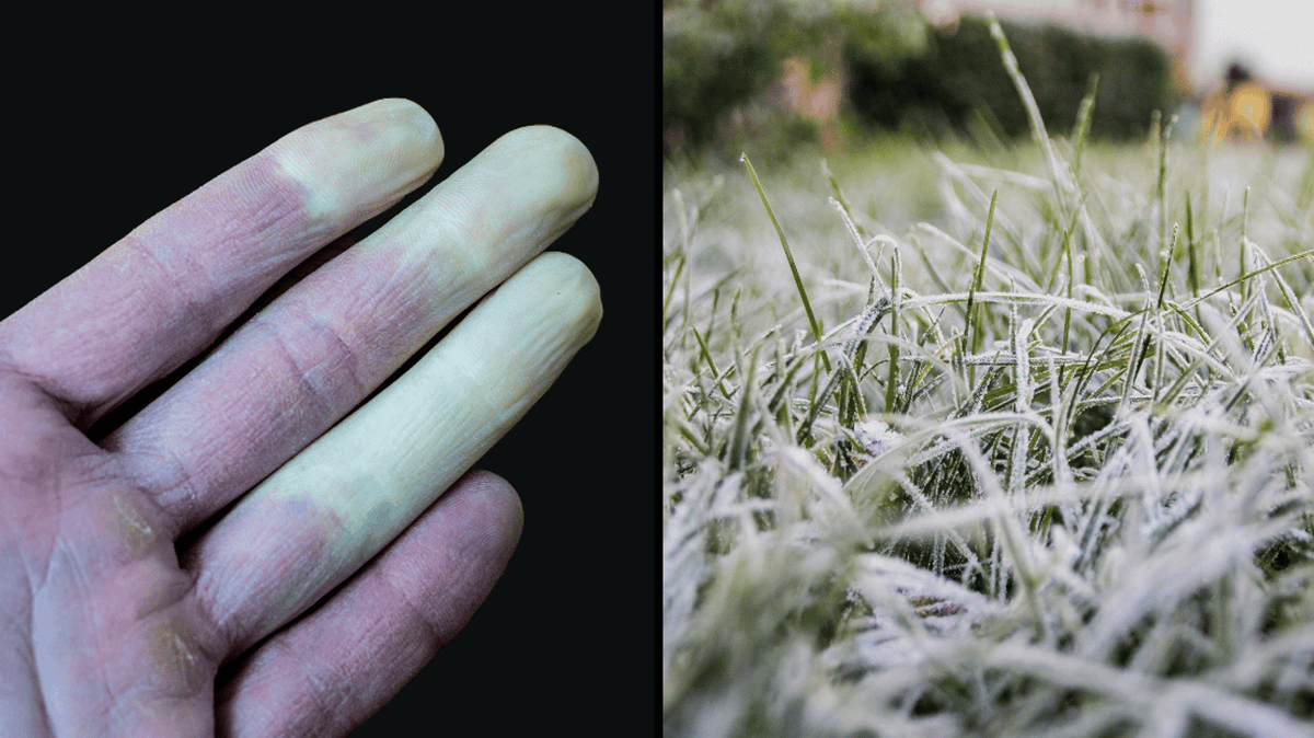 Common disease could be why your fingers turn a different colour in ...