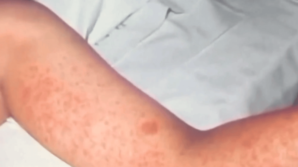 ‘World’s most contagious disease’ spreads in US with more than 100 kids exposed