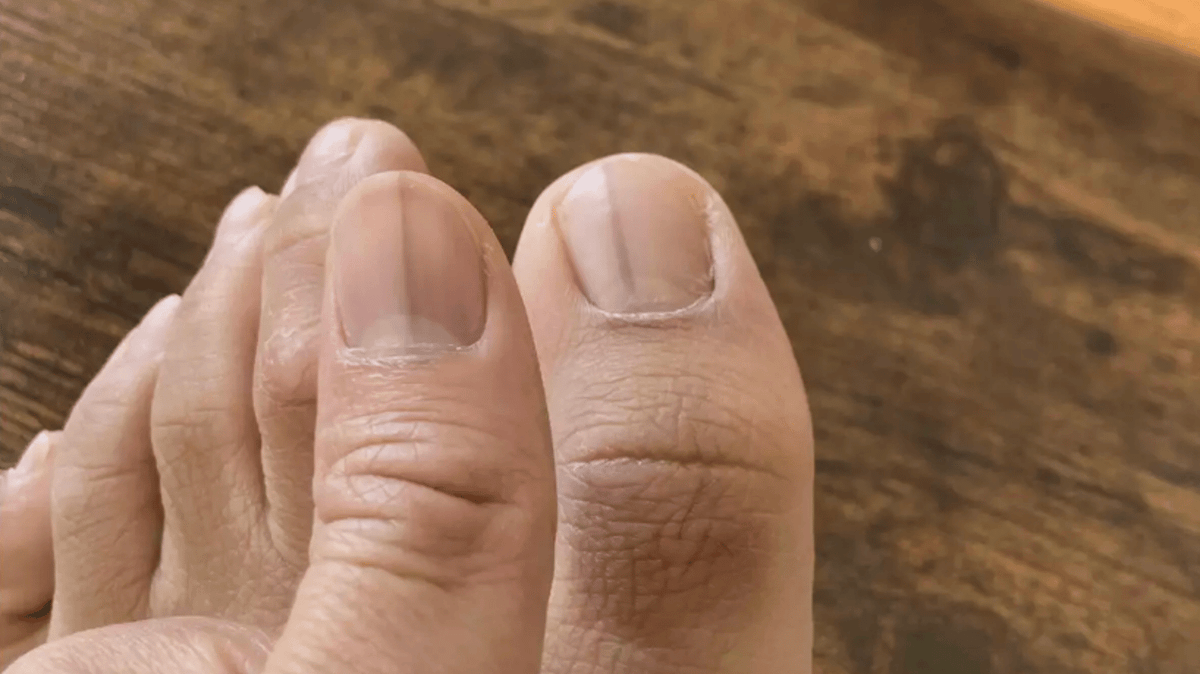 Woman urged to see doctor after seemingly innocent image of toe reveals ...