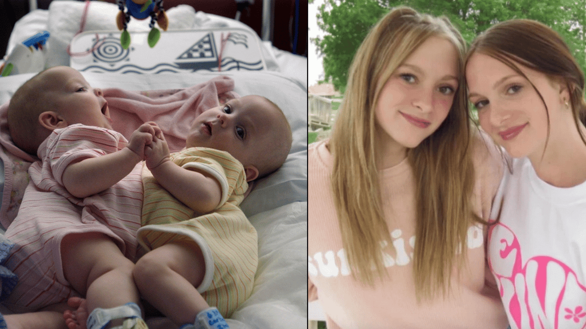 Conjoined twins who were separated as babies shared update on their lives  10 years later