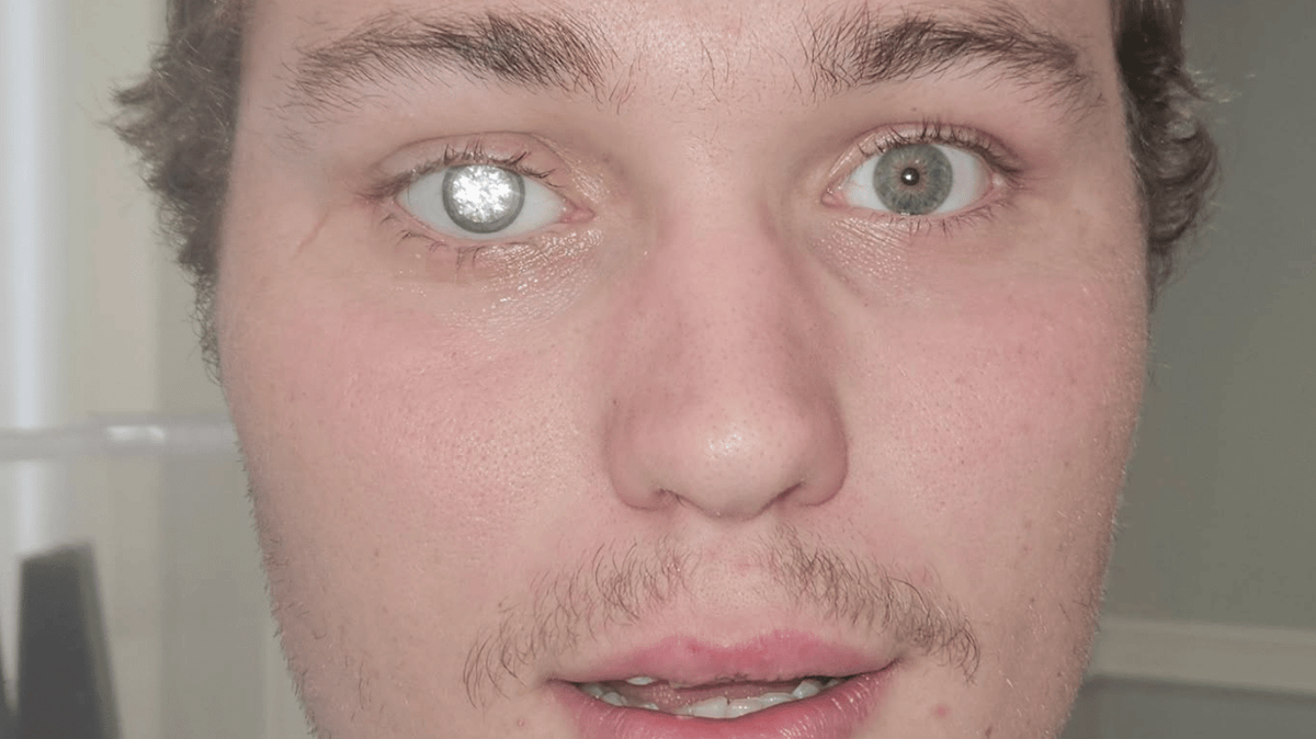 Man explains why he got $2million diamond embedded into his eye as ...
