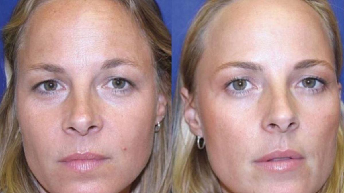 All changes that happened to identical twins when one used Botox for 20 ...