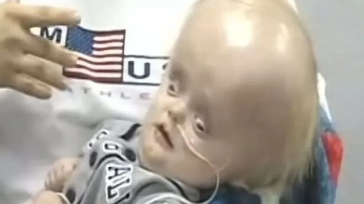 Brain Less Baby Boy born without a brain lived to the age of 12