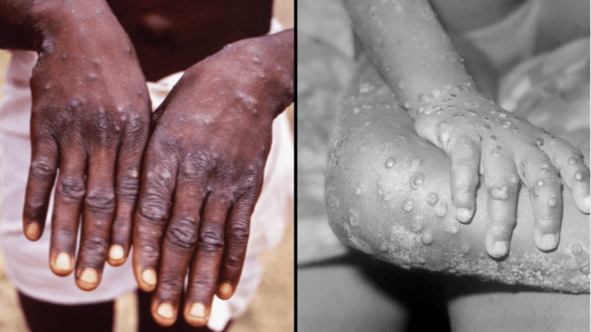 Australia Detects First 'Probable' Case Of Monkeypox With Patient Now ...
