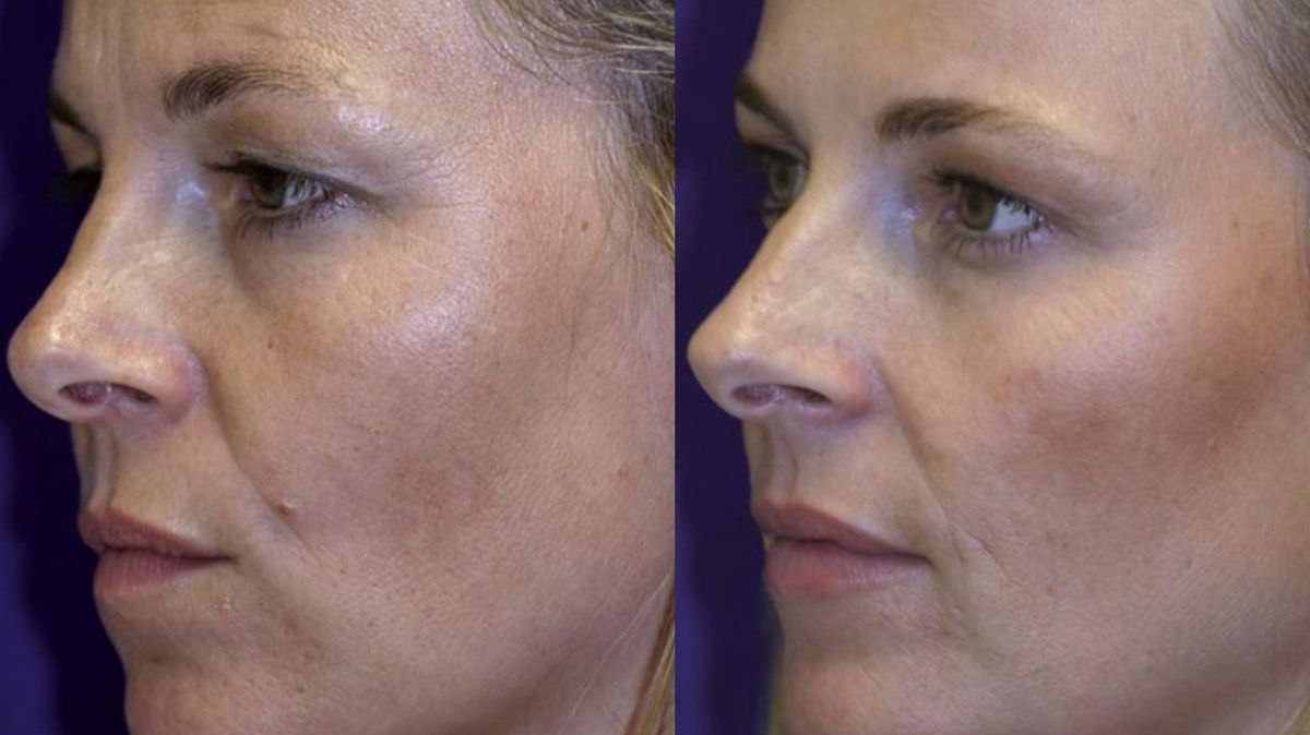 Identical twins show dramatic differences after one uses botox for 20 years and the other doesn't