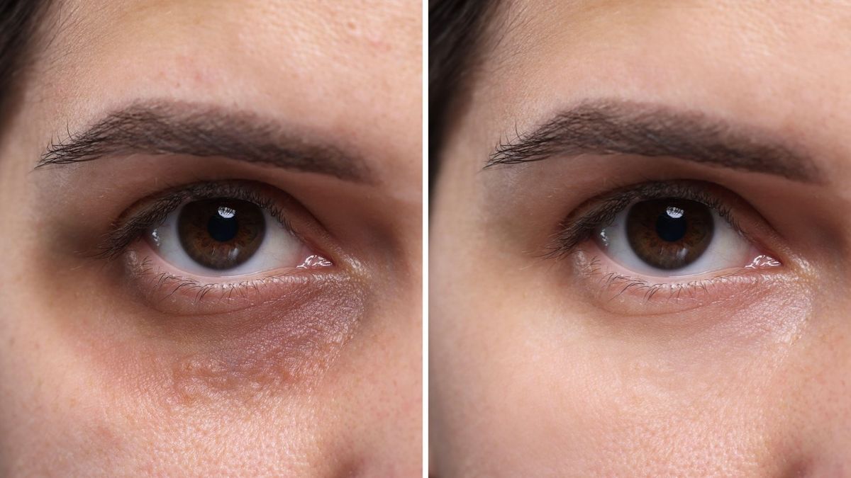 'Ferritin face’ social media trend has people trying to spot 'warning signs' in own reflection