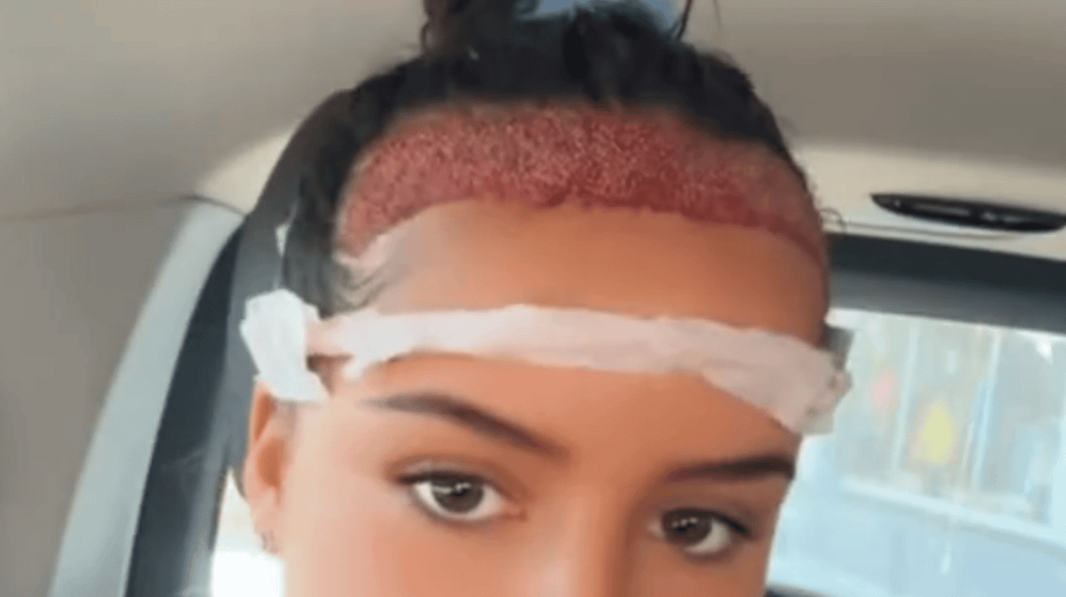 Teenage girl speaks out after flying to Turkey for hair transplant at age 16