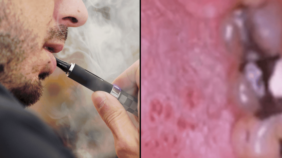 Vape Rashes Dentist shows red spots which form in blind spot when you vape