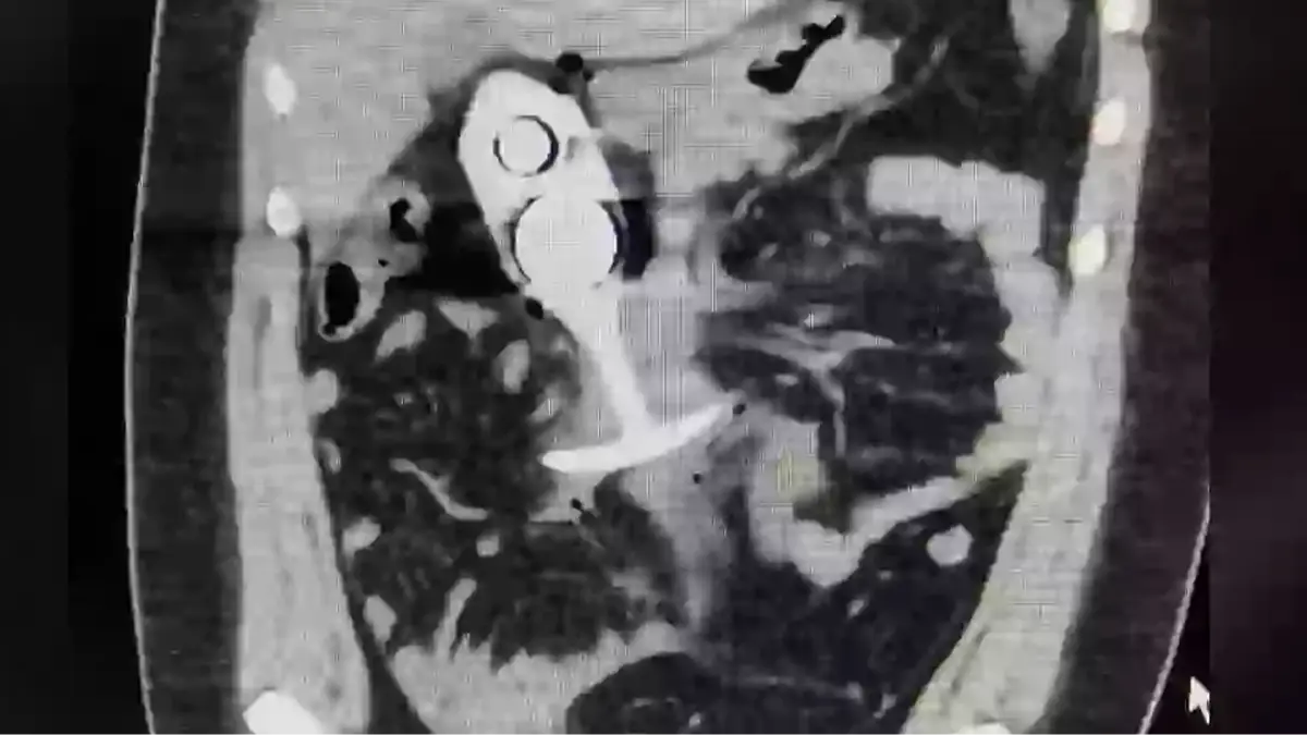 Woman left 'screaming' in pain after leaving sex toy in during MRI as  warnings are issued