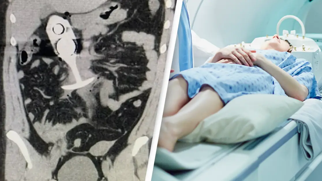 Woman left 'screaming' in pain after leaving in sex toy during MRI scan as warnings are Woman left 'screaming' in pain after leaving in sex toy during MRI scan as warnings are