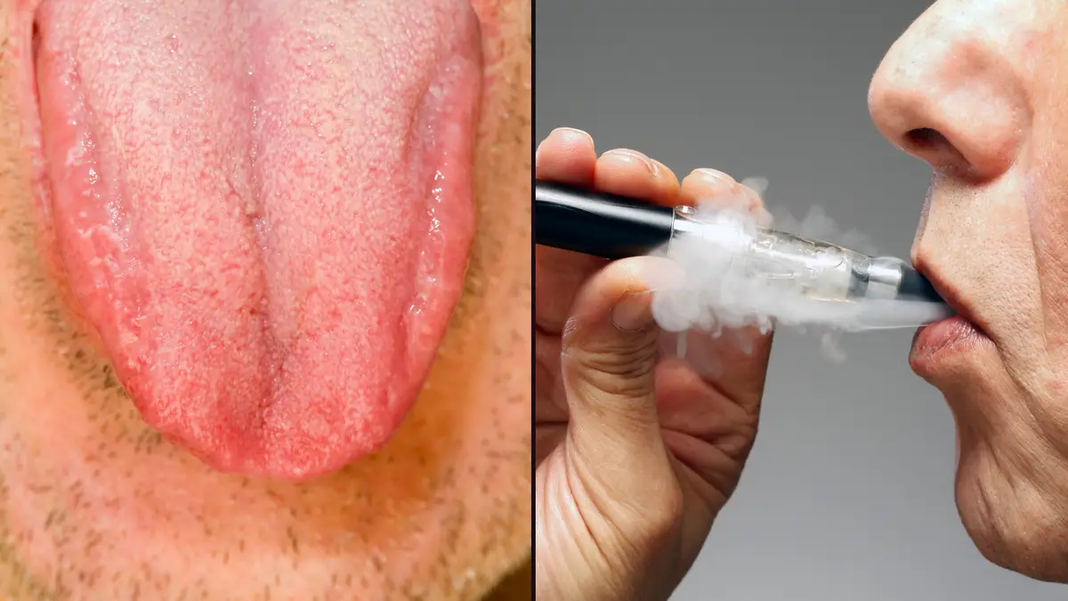burnt tongue from vape Expert reveals shocking long-term side effect of 'Vaper's Tongue' that will  put many people off