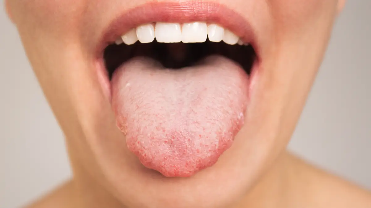 semaglutide tongue Ozempic tongue' is latest side effect of drug a number of celebs shared  experience using