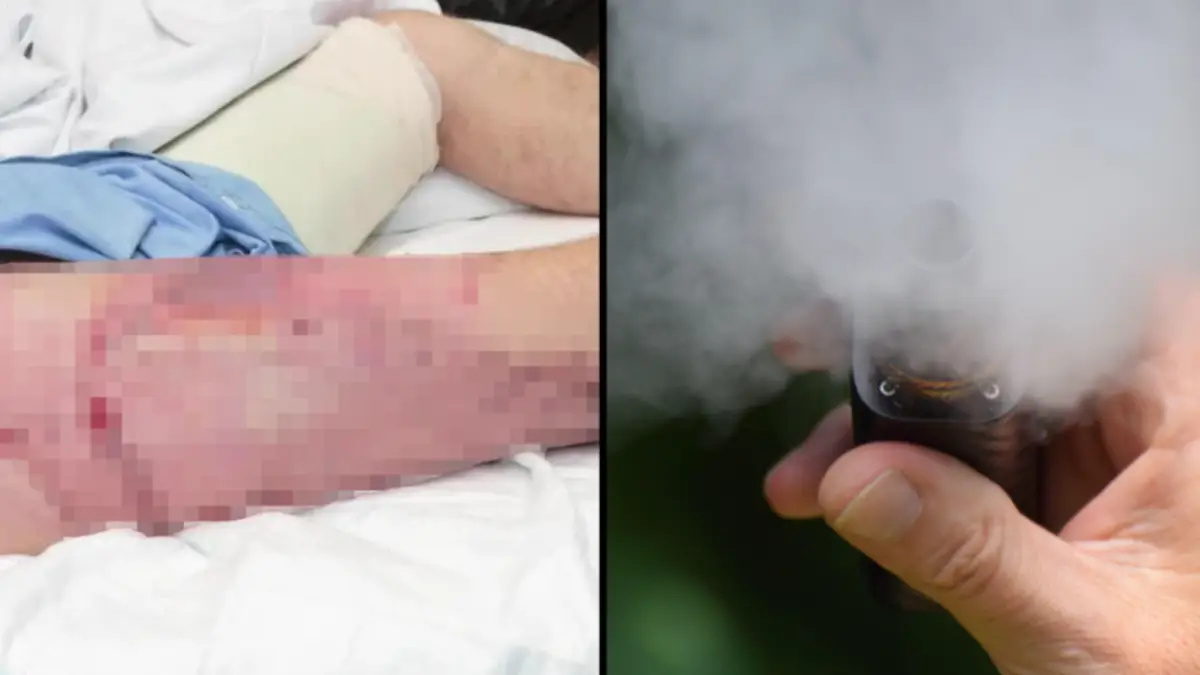 elfbar elfa master akku Man burned by exploding e-cigarette main image 1