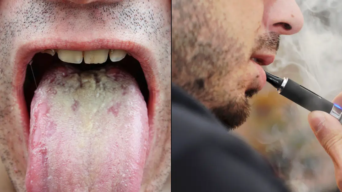 canapuff vapes Dentist issues warning over grim side effects of 'Vaper's Tongue'