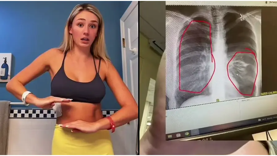elfbar elfa master akku A Case Report of Secondary Spontaneous Pneumothorax Induced by Vape