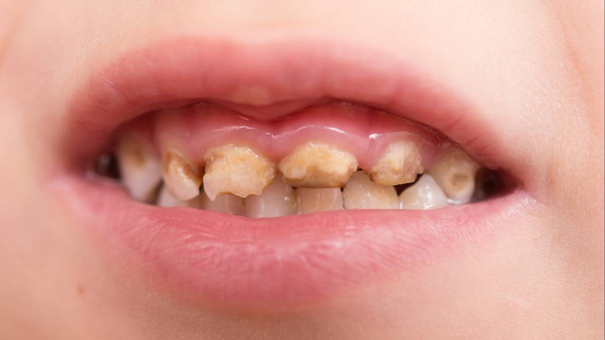 One-in-six children now suffering from dental condition that causes discoloured and crumbling teeth