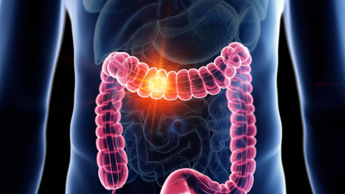 Oncologist who cut open people for 17 years saw same foods in 80% of colon cancer patients