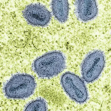 NIH-NIAID/Image Point FR/BSIP/Universal Images Group via Getty Images