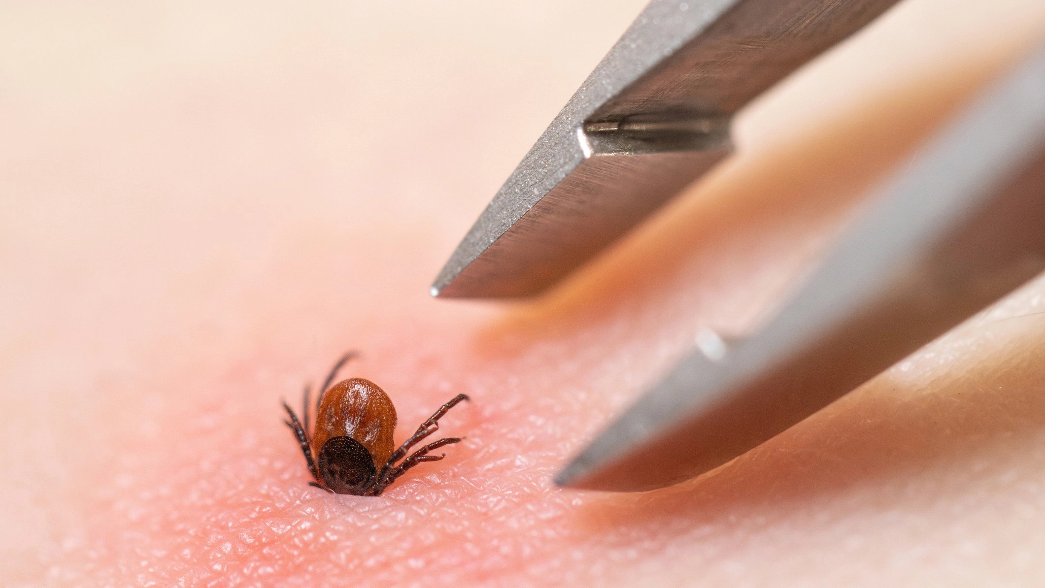 How a tick bite can suddenly make you allergic to red meat