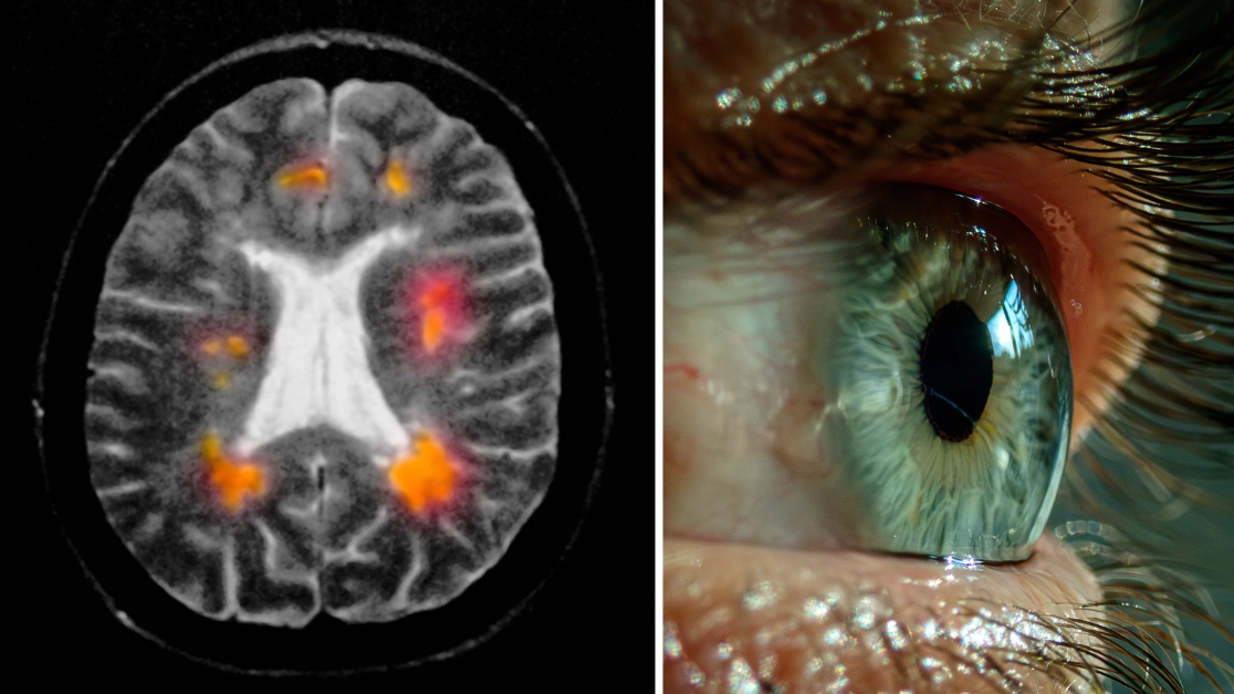 Early sign of MS to look out for that could appear in your eyes