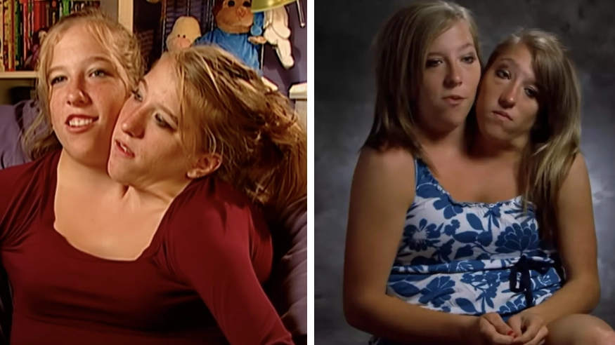 Conjoined twins Abby and Brittany Hensel dream of getting married and having children of their own