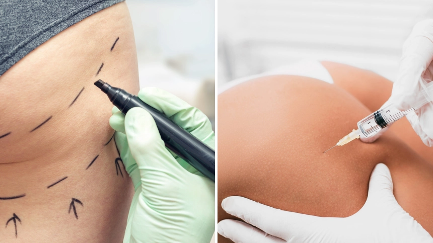 NHS advice on BBL surgery following woman fearing amputation after liquid BBL treatment