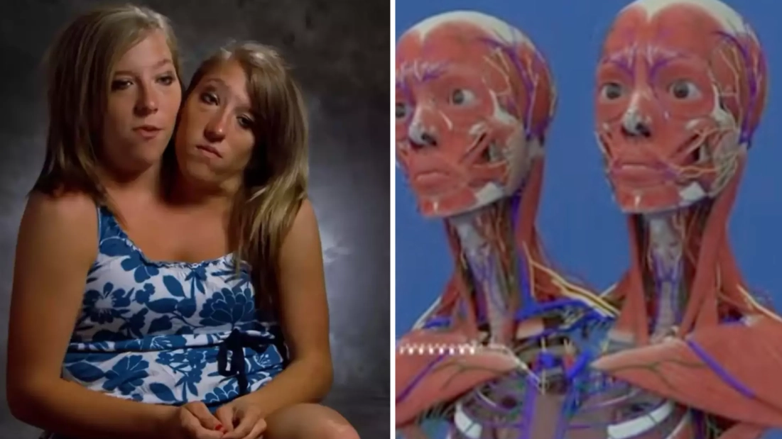 Conjoined twins Abby and Brittany Hensel leave fans in disbelief as they reveal how their bodies are actually connected