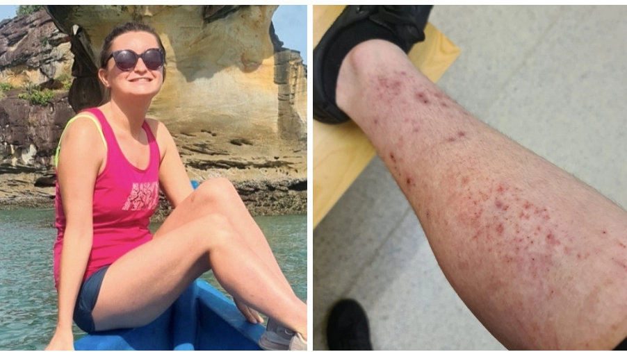 Woman says miracle drug cured eczema that left her bed bound for decades