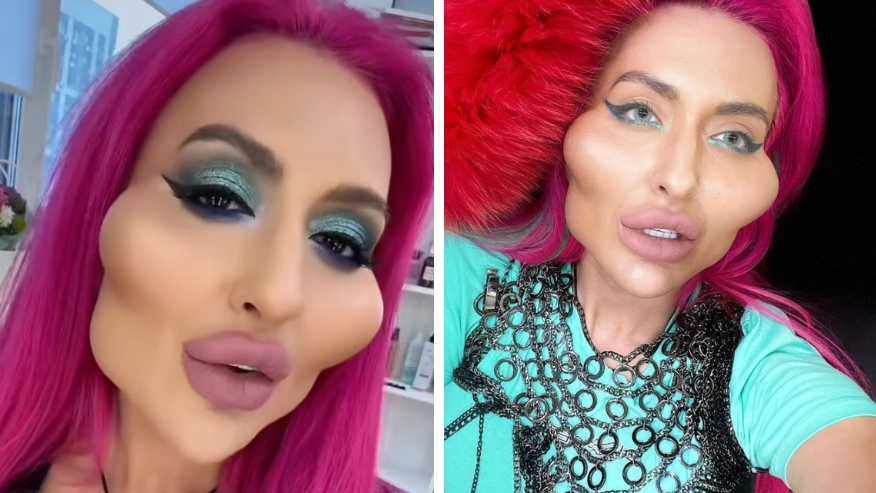 Woman with 'world's biggest cheeks' shows what she looked like before surgery