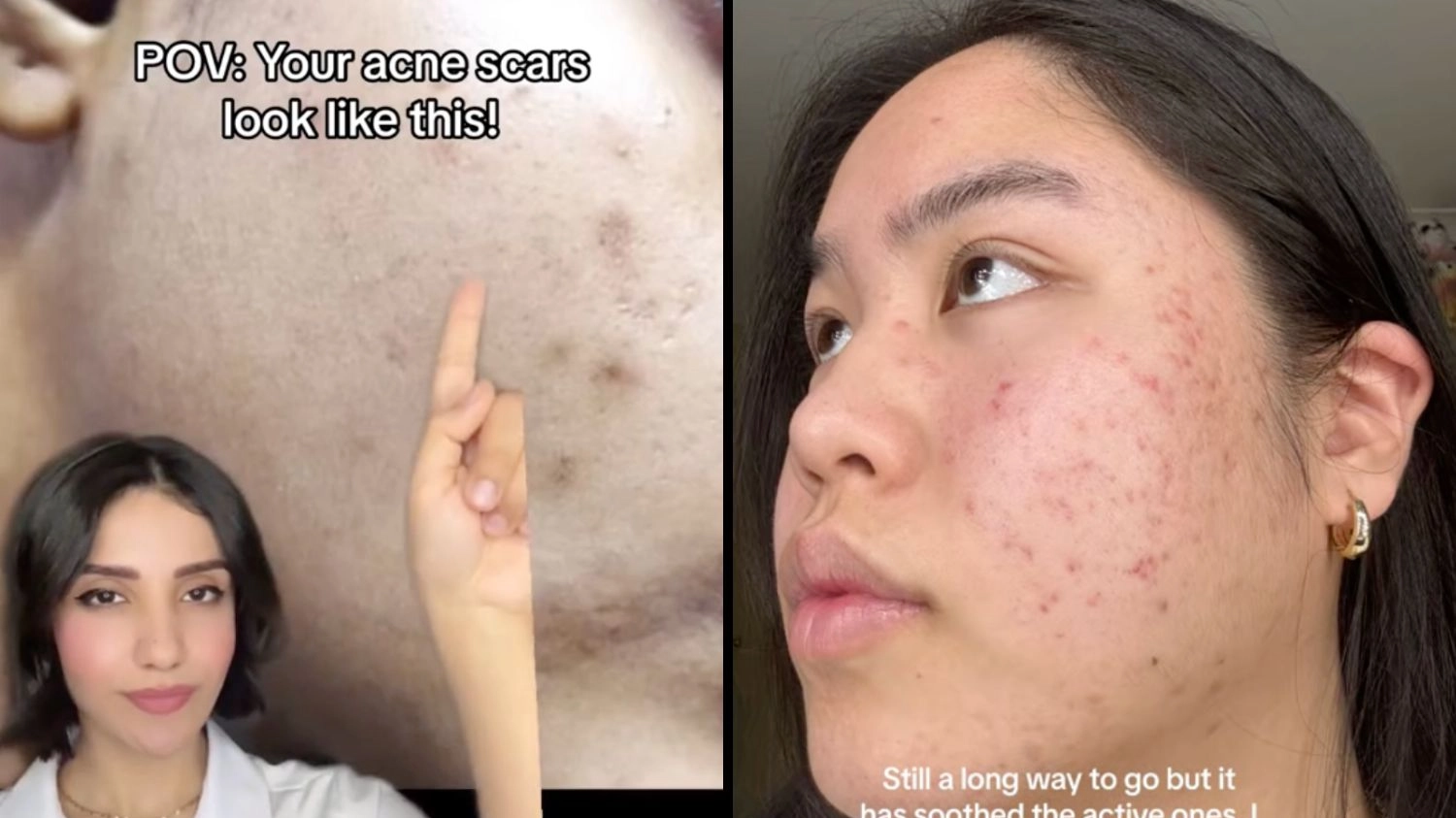 People call £14 serum 'magic in a bottle' for acne scars with 'results in just one week'