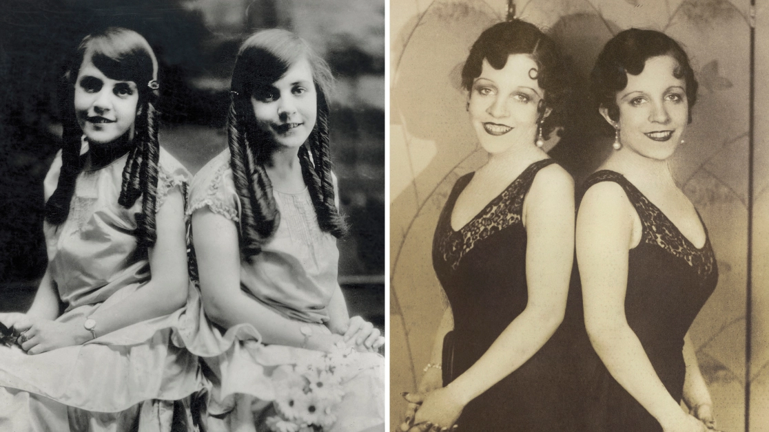 Disturbing case of conjoined twin who was forced to live with dead sister attached to her