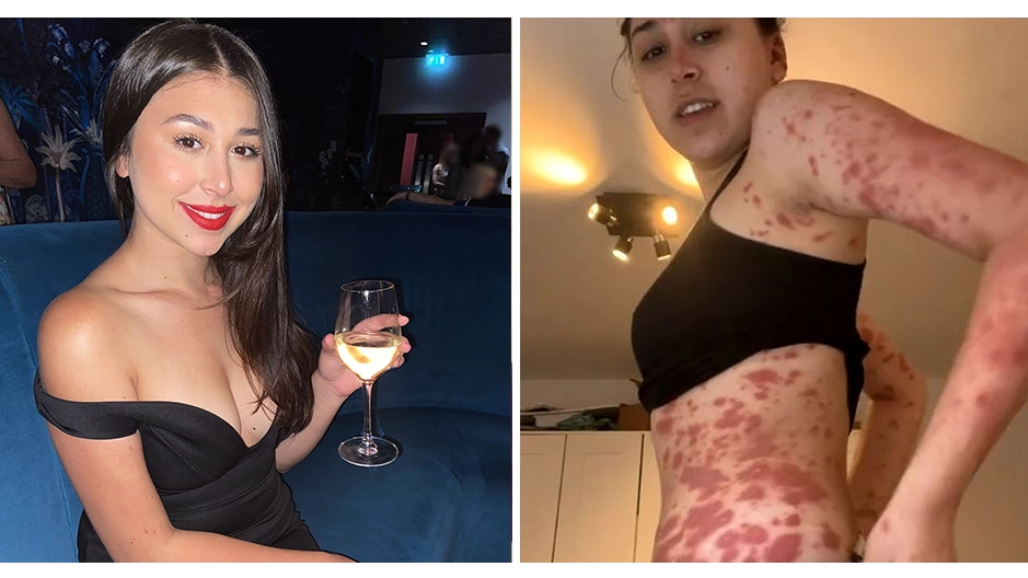 Student's Stark Vaping Warning After Habit Triggered Skin Condition