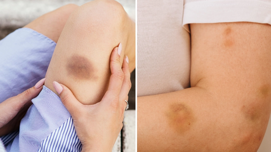 Doctor reveals reason why you’re bruising so easily