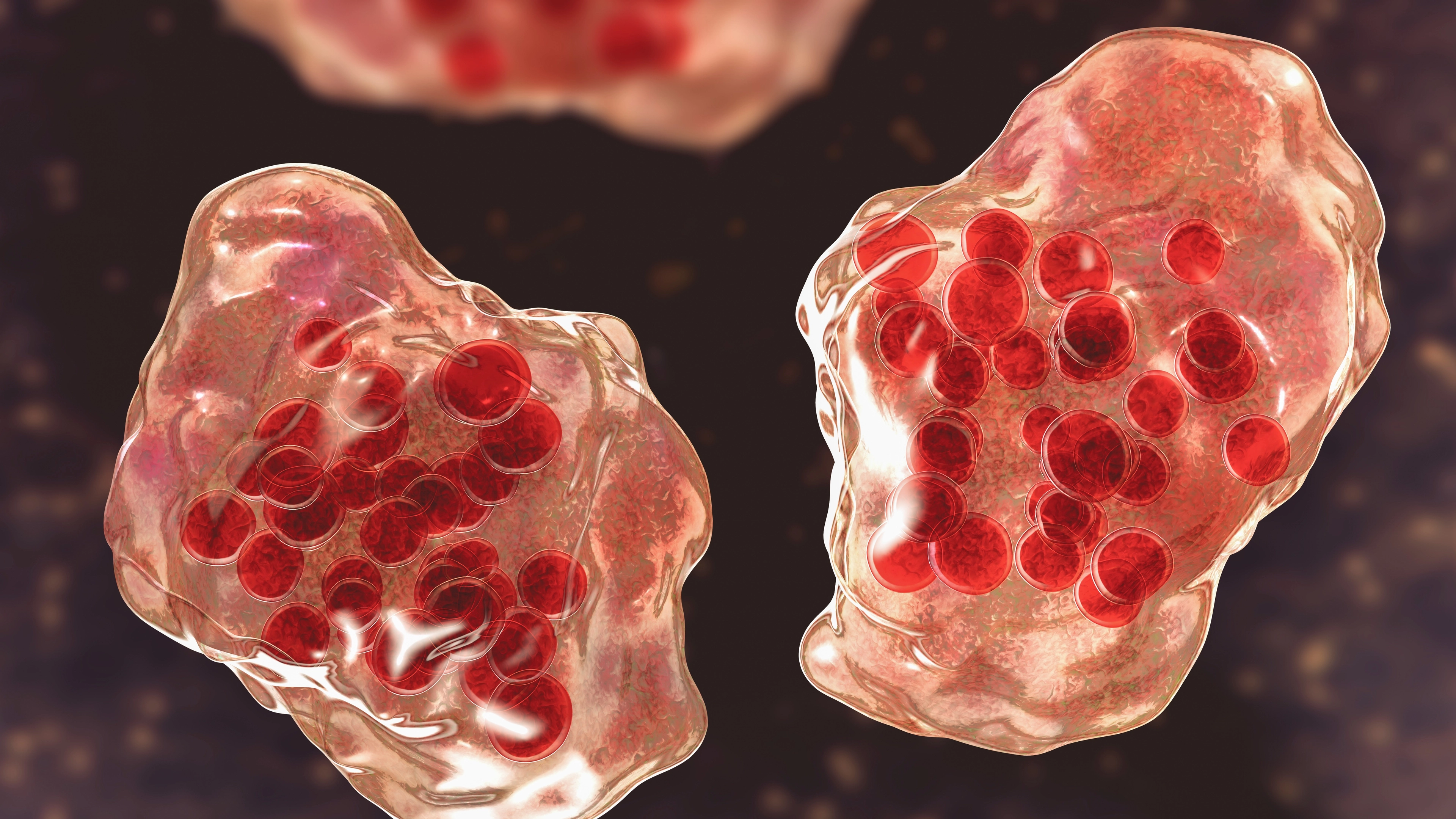 Little-known measles symptoms you need to watch out for as cases surge in parts of US