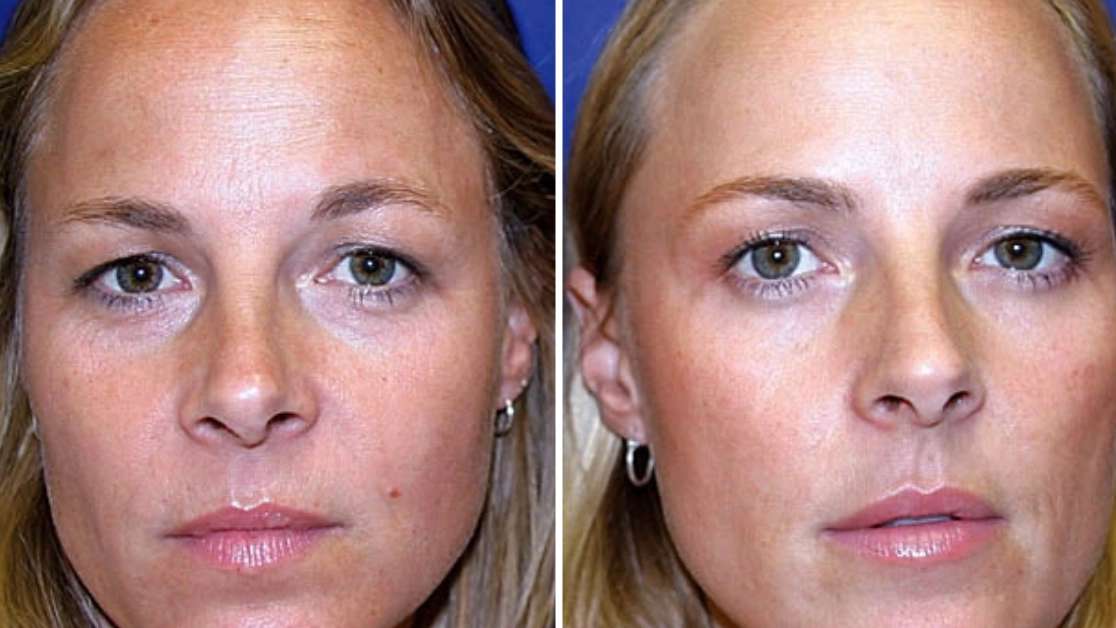 Identical twins reveal shocking results after one used Botox for 13 years whilst the other didn’t