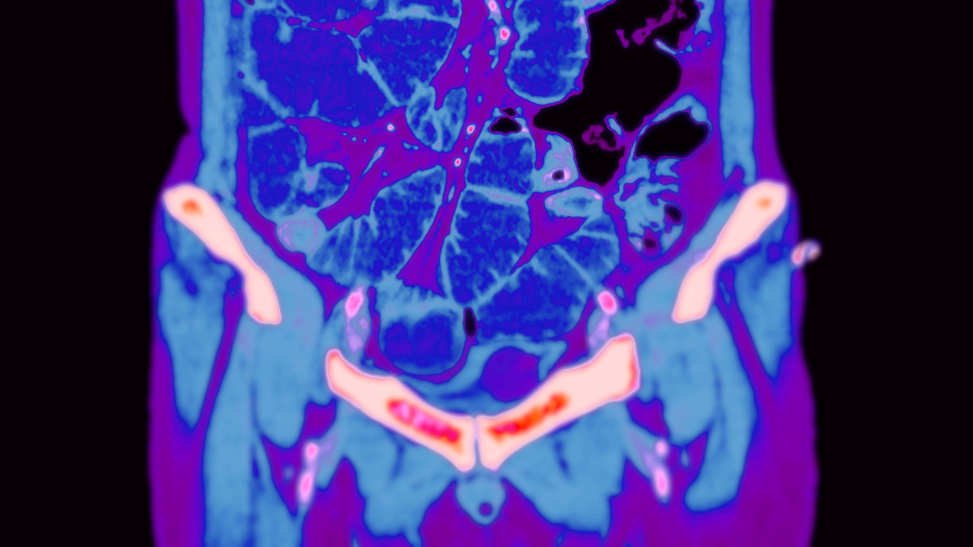 Extremely rare type of cancer has quadrupled in millennials as 'tip of the iceberg' warning is issued