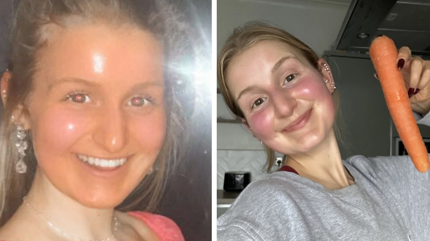 Woman says eating too many carrots turned her skin bright orange 'like an Oompa Loompa'