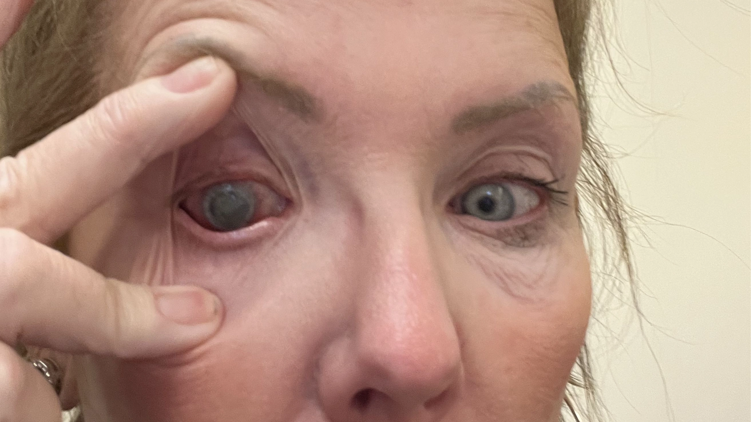 Lifeguard blinded and forced to quit job after horrific contact lenses mistake