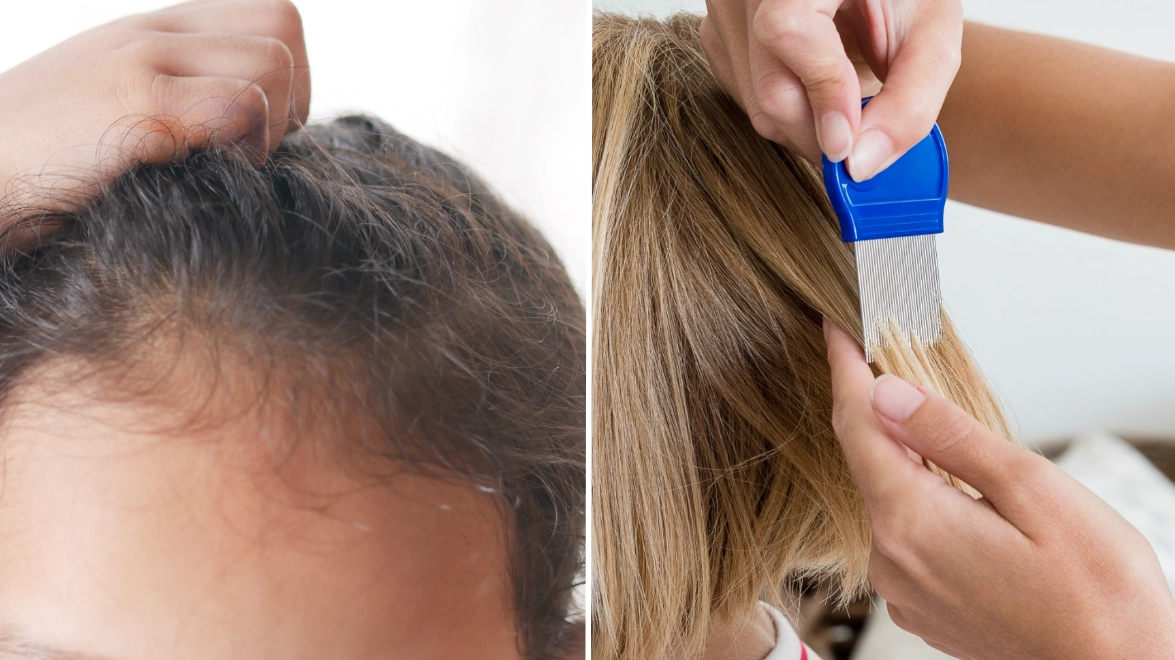 Expert warns against popular hack for getting rid of headlice