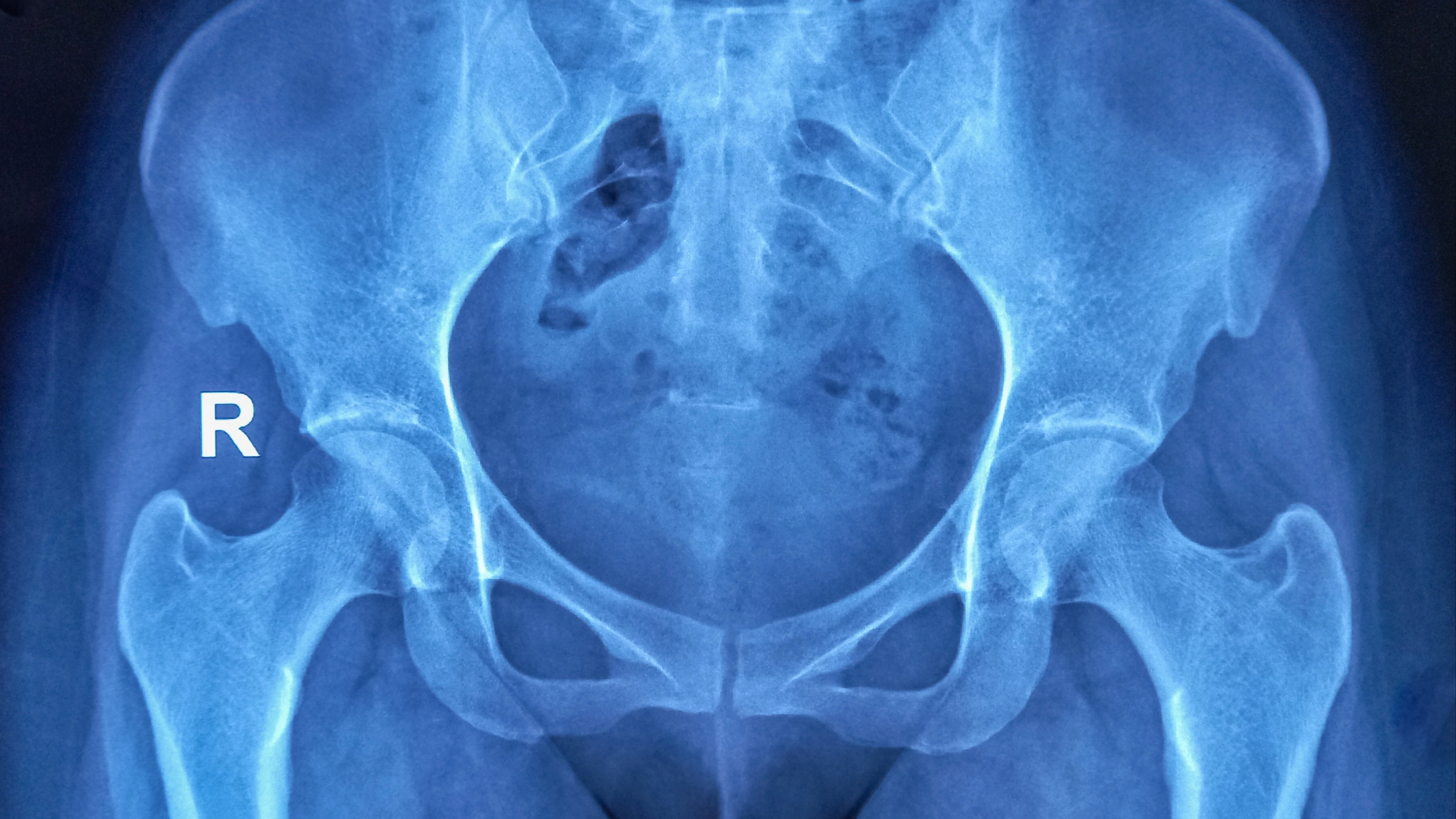 Why you might be getting ‘lightning crotch’ and what to do about it