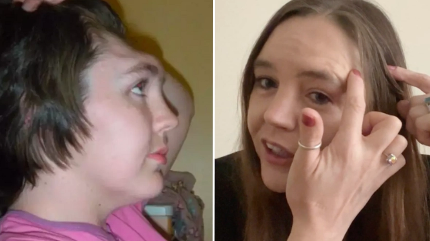 Woman left with no forehead after crash has spare one just in case it needs replacing