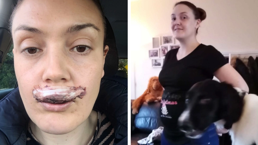 Woman left with life changing injuries after being bitten by her own dog in freak attack