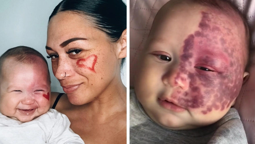 Mum called a 'monster' for choosing to laser birthmark on baby's face